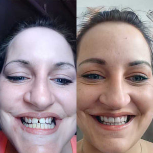 Boost Clear Aligners For Your Clinic| Before After Results